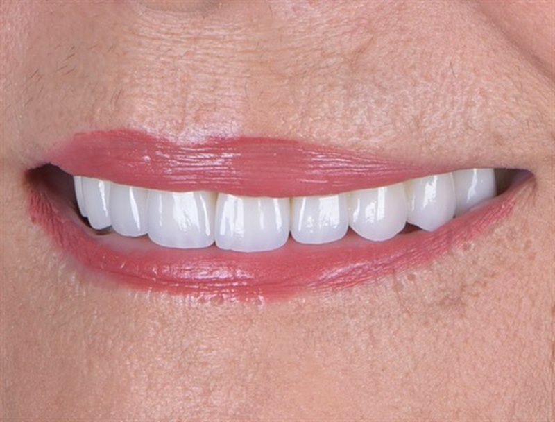Patient's smile after treatment at Dentalii
