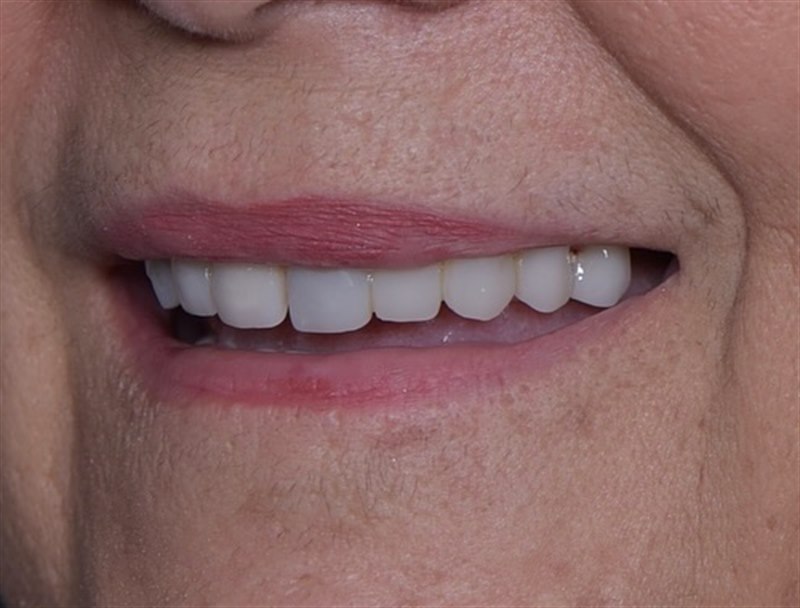 Patient's smile before treatment at Dentalii