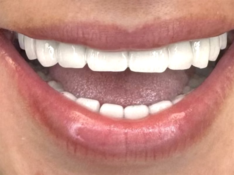 Patient's smile after treatment at Dentalii