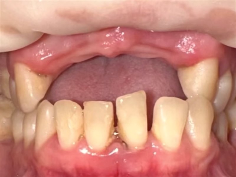 Patient's smile before treatment at Dentalii