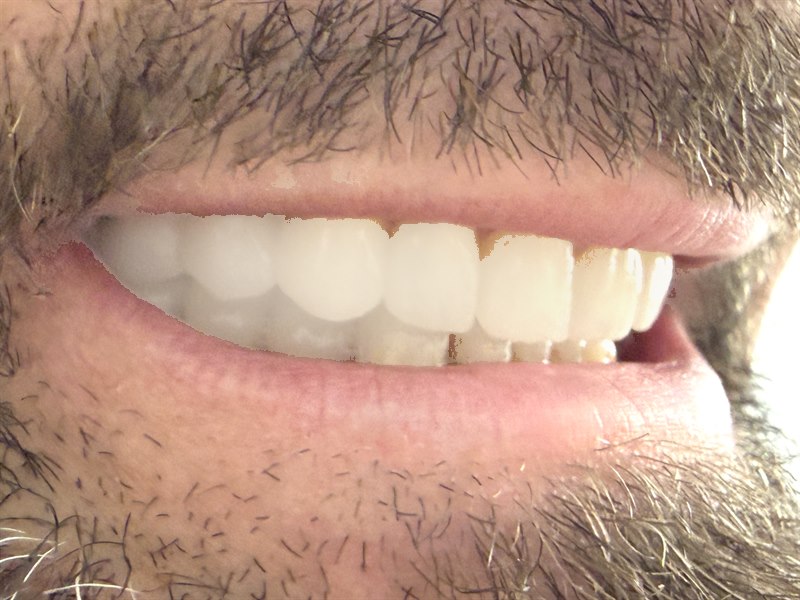 Patient's smile after treatment at Dentalii