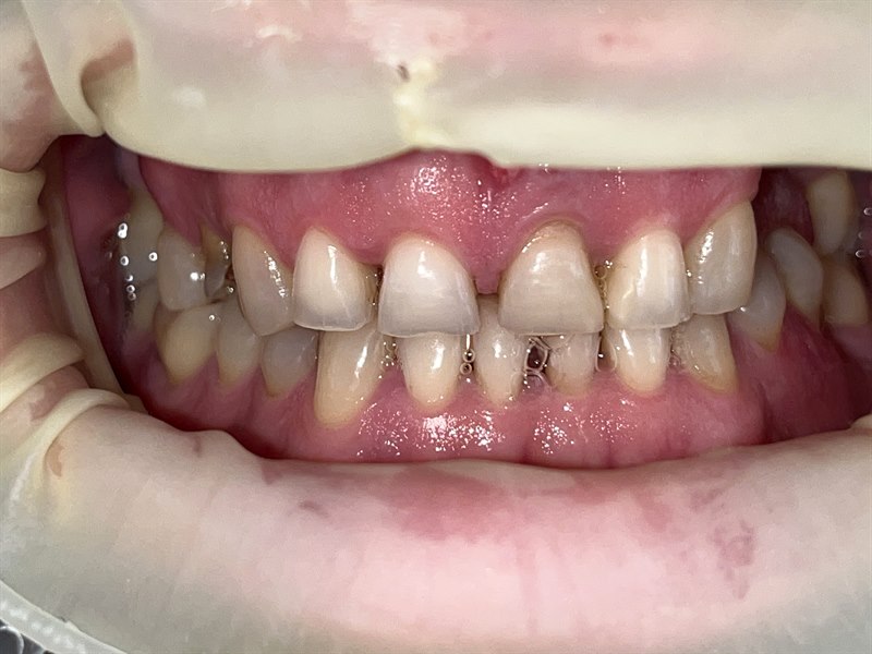 Patient's smile before treatment at Dentalii